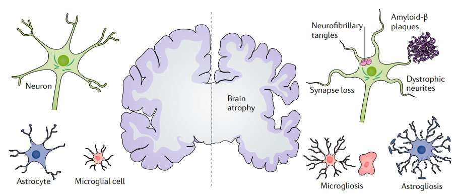 The major pathological hallmarks of Alzheimer's disease.png