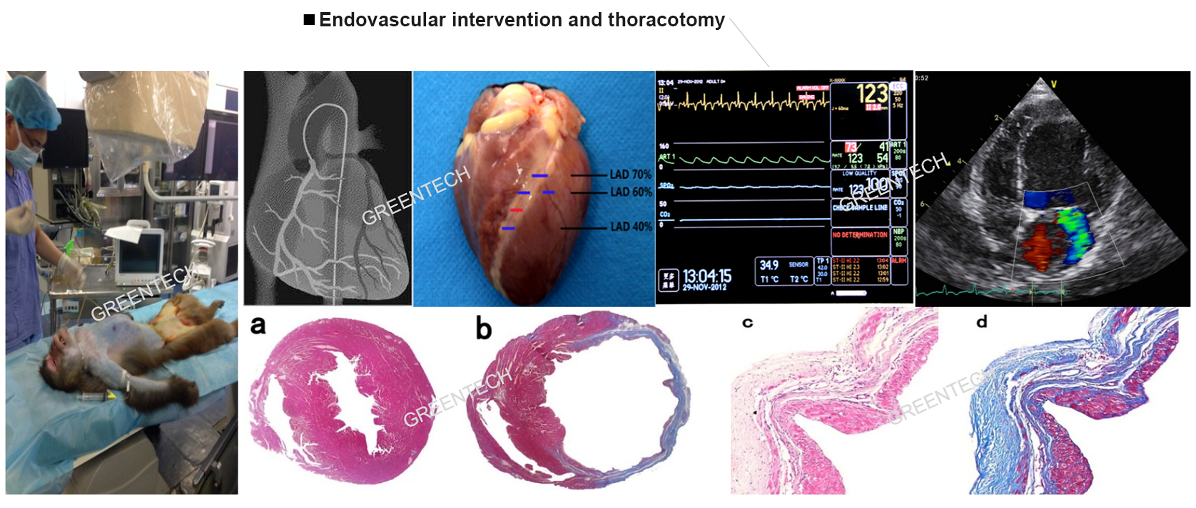Endovascular intervention and thoracotomy.png