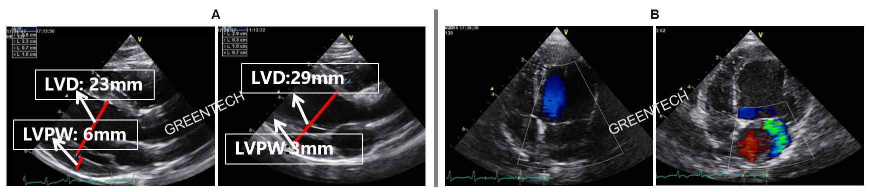 Myocardial ischemia-induced ventricular remodeling.png