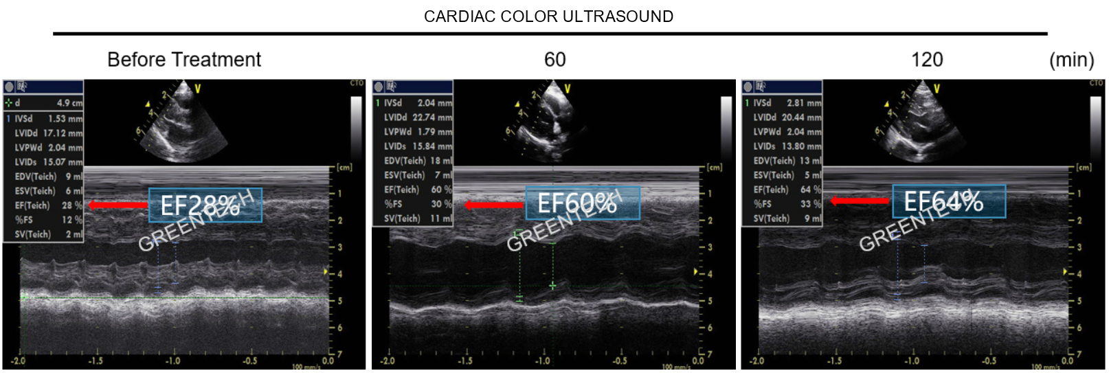 Cardiac color ultrasound examination in NHP models of rapid pacing-induced heart failure.png
